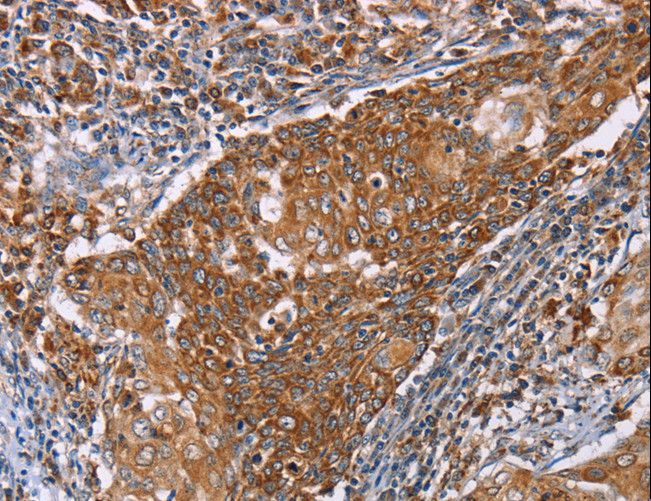 PMPCB / MPP11 Antibody - Immunohistochemistry of paraffin-embedded Human esophagus cancer using PMPCB Polyclonal Antibody at dilution of 1:50.
