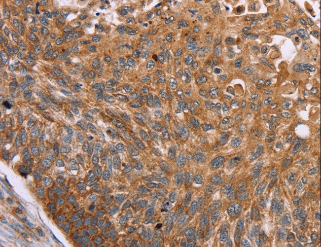 PMPCB / MPP11 Antibody - Immunohistochemistry of paraffin-embedded Human esophagus cancer using PMPCB Polyclonal Antibody at dilution of 1:50.