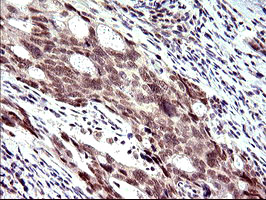 PMS2 Antibody - IHC of paraffin-embedded Adenocarcinoma of Human breast tissue using anti-PMS2 mouse monoclonal antibody. (Heat-induced epitope retrieval by 10mM citric buffer, pH6.0, 120°C for 3min).