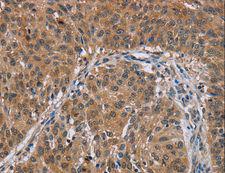 PMS2 Antibody - Immunohistochemistry of paraffin-embedded Human lung cancer using PMS2 Polyclonal Antibody at dilution of 1:30.