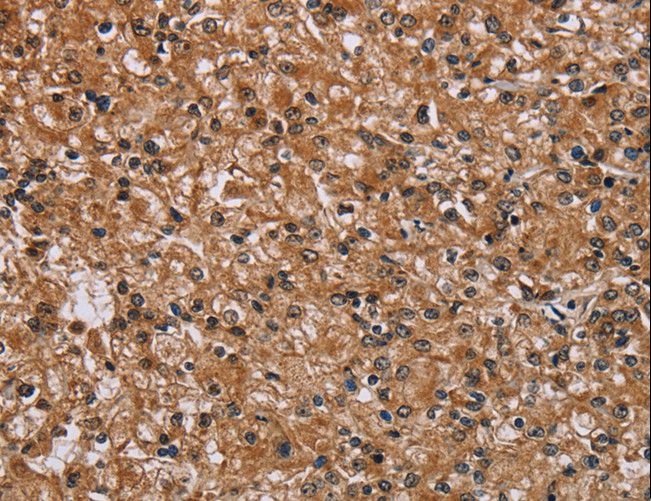 PMS2 Antibody - Immunohistochemistry of paraffin-embedded Human prostate cancer using PMS2 Polyclonal Antibody at dilution of 1:30.