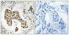 PMS2 Antibody - Peptide - + Immunohistochemistry analysis of paraffin-embedded human breast carcinoma tissue using PMS2/PMS2CL antibody.