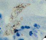 Pneumocystis jiroveci Antibody - IHC of Pneumocystis carinii on FFPE Infected Lung tissue.