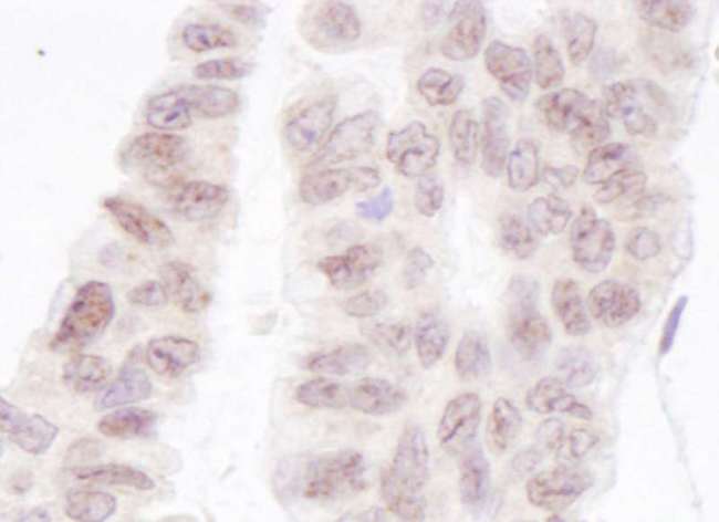 PNKP Antibody - Detection of Human PNK1 by Immunohistochemistry. Sample: FFPE section of human ovarian carcinoma. Antibody: Affinity purified rabbit anti-PNK1 used at a dilution of 1:5000 (0.2 ug/ml). Detection: DAB.