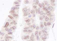 PNKP Antibody - Detection of Human PNK1 by Immunohistochemistry. Sample: FFPE section of human ovarian carcinoma. Antibody: Affinity purified rabbit anti-PNK1 used at a dilution of 1:5000 (0.2 ug/ml). Detection: DAB.