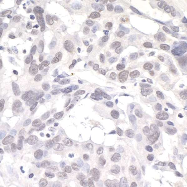 PNKP Antibody - Detection of human PNK1 by immunohistochemistry. Sample: FFPE section of human ovarian carcinoma. Antibody: Affinity purified rabbit anti- PNK1 used at a dilution of 1:1,000 (1 µg/ml). Detection: DAB