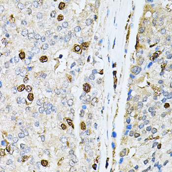 PNKP Antibody - Immunohistochemistry of paraffin-embedded human prostate cancer tissue.