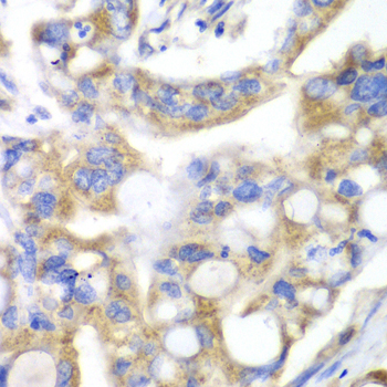 PNLIP / PL / Pancreatic Lipase Antibody - Immunohistochemistry of paraffin-embedded human liver cancer tissue.