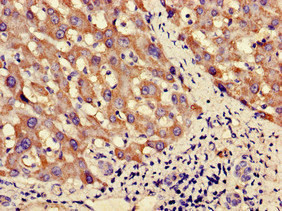 PNLIPRP3 Antibody - Immunohistochemistry of paraffin-embedded human liver cancer using PNLIPRP3 Antibody at dilution of 1:100
