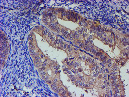 PNMA3 Antibody - IHC of paraffin-embedded Adenocarcinoma of Human endometrium tissue using anti-PNMA3 mouse monoclonal antibody.