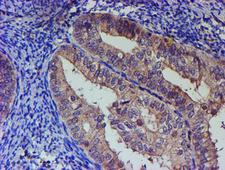 PNMA3 Antibody - IHC of paraffin-embedded Adenocarcinoma of Human endometrium tissue using anti-PNMA3 mouse monoclonal antibody.