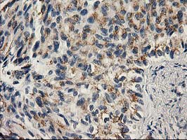 PNMT Antibody - IHC of paraffin-embedded Carcinoma of Human lung tissue using anti-PNMT mouse monoclonal antibody. (Heat-induced epitope retrieval by 10mM citric buffer, pH6.0, 100C for 10min).