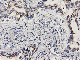 PNMT Antibody - IHC of paraffin-embedded Carcinoma of Human lung tissue using anti-PNMT mouse monoclonal antibody. (Heat-induced epitope retrieval by 10mM citric buffer, pH6.0, 100C for 10min).