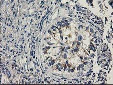 PNMT Antibody - IHC of paraffin-embedded Carcinoma of Human lung tissue using anti-PNMT mouse monoclonal antibody.