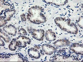 PNMT Antibody - IHC of paraffin-embedded Carcinoma of Human prostate tissue using anti-PNMT mouse monoclonal antibody.