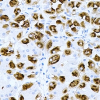 PNMT Antibody - Immunohistochemical analysis of PNMTase staining in human gastric cancer formalin fixed paraffin embedded tissue section. The section was pre-treated using heat mediated antigen retrieval with sodium citrate buffer (pH 6.0). The section was then incubated with the antibody at room temperature and detected using an HRP conjugated compact polymer system. DAB was used as the chromogen. The section was then counterstained with hematoxylin and mounted with DPX.