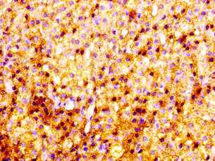 PNMT Antibody - Immunohistochemistry image at a dilution of 1:100 and staining in paraffin-embedded human adrenal gland tissue performed on a Leica BondTM system. After dewaxing and hydration, antigen retrieval was mediated by high pressure in a citrate buffer (pH 6.0) . Section was blocked with 10% normal goat serum 30min at RT. Then primary antibody (1% BSA) was incubated at 4 °C overnight. The primary is detected by a biotinylated secondary antibody and visualized using an HRP conjugated SP system.