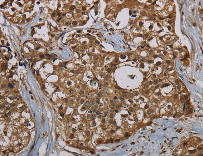 PNN / Pinin Antibody - Immunohistochemistry of paraffin-embedded Human breast cancer using PNN Polyclonal Antibody at dilution of 1:50.
