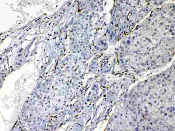 PNP / Nucleoside Phosphorylase Antibody - IHC analysis of PNP using anti-PNP antibody. PNP was detected in paraffin-embedded section of human liver cancer tissues. Heat mediated antigen retrieval was performed in citrate buffer (pH6, epitope retrieval solution) for 20 mins. The tissue section was blocked with 10% goat serum. The tissue section was then incubated with 1µg/ml rabbit anti-PNP Antibody overnight at 4°C. Biotinylated goat anti-rabbit IgG was used as secondary antibody and incubated for 30 minutes at 37°C. The tissue section was developed using Strepavidin-Biotin-Complex (SABC) with DAB as the chromogen.