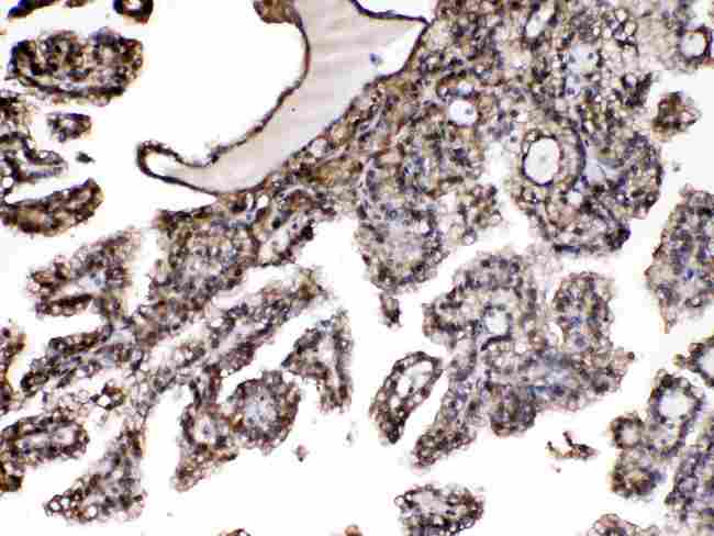 PNP / Nucleoside Phosphorylase Antibody - IHC analysis of PNP using anti-PNP antibody. PNP was detected in paraffin-embedded section of human renal cancer tissues. Heat mediated antigen retrieval was performed in citrate buffer (pH6, epitope retrieval solution) for 20 mins. The tissue section was blocked with 10% goat serum. The tissue section was then incubated with 1µg/ml rabbit anti-PNP Antibody overnight at 4°C. Biotinylated goat anti-rabbit IgG was used as secondary antibody and incubated for 30 minutes at 37°C. The tissue section was developed using Strepavidin-Biotin-Complex (SABC) with DAB as the chromogen.