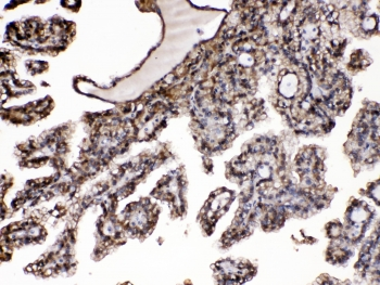 PNP / Nucleoside Phosphorylase Antibody - IHC testing of FFPE human renal cancer tissue with Purine nucleoside phosphorylase antibody at 1ug/ml. HIER: steam section in pH6 citrate buffer for 20 min.
