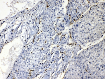 PNP / Nucleoside Phosphorylase Antibody - IHC testing of FFPE human liver cancer tissue with Purine nucleoside phosphorylase antibody at 1ug/ml. HIER: steam section in pH6 citrate buffer for 20 min.