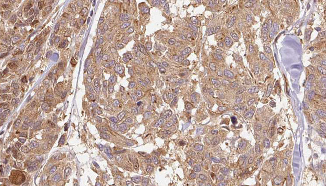 PNP / Nucleoside Phosphorylase Antibody - 1:100 staining human Melanoma tissue by IHC-P. The sample was formaldehyde fixed and a heat mediated antigen retrieval step in citrate buffer was performed. The sample was then blocked and incubated with the antibody for 1.5 hours at 22°C. An HRP conjugated goat anti-rabbit antibody was used as the secondary.
