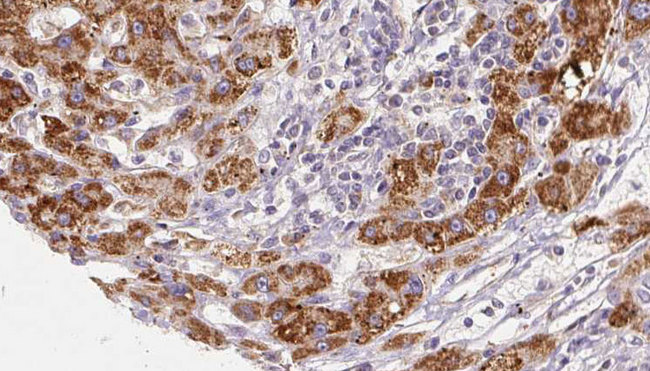 PNPLA2 / ATGL Antibody - 1:100 staining human liver carcinoma tissues by IHC-P. The sample was formaldehyde fixed and a heat mediated antigen retrieval step in citrate buffer was performed. The sample was then blocked and incubated with the antibody for 1.5 hours at 22°C. An HRP conjugated goat anti-rabbit antibody was used as the secondary.