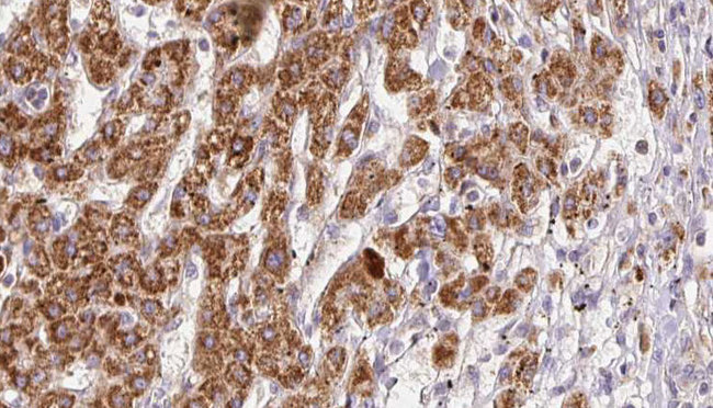 PNPLA2 / ATGL Antibody - 1:100 staining human liver carcinoma tissues by IHC-P. The sample was formaldehyde fixed and a heat mediated antigen retrieval step in citrate buffer was performed. The sample was then blocked and incubated with the antibody for 1.5 hours at 22°C. An HRP conjugated goat anti-rabbit antibody was used as the secondary.