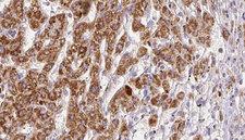 PNPLA2 / ATGL Antibody - 1:100 staining human liver carcinoma tissues by IHC-P. The sample was formaldehyde fixed and a heat mediated antigen retrieval step in citrate buffer was performed. The sample was then blocked and incubated with the antibody for 1.5 hours at 22°C. An HRP conjugated goat anti-rabbit antibody was used as the secondary.
