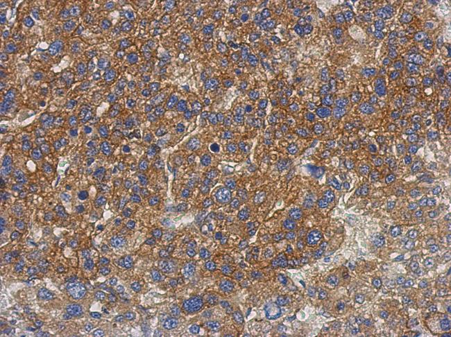 PNPLA4 Antibody - IHC of paraffin-embedded Hepatoma, using GS2 antibody at 1:500 dilution.
