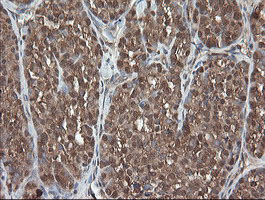 PNPO Antibody - IHC of paraffin-embedded Carcinoma of Human thyroid tissue using anti-PNPO mouse monoclonal antibody.