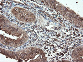 PNPO Antibody - IHC of paraffin-embedded Adenocarcinoma of Human endometrium tissue using anti-PNPO mouse monoclonal antibody.