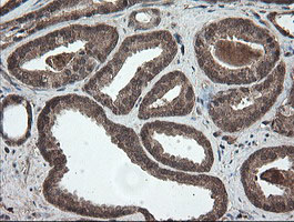 PNPO Antibody - IHC of paraffin-embedded Carcinoma of Human prostate tissue using anti-PNPO mouse monoclonal antibody.