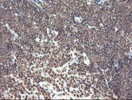 PNPO Antibody - IHC of paraffin-embedded Human lymphoma tissue using anti-PNPO mouse monoclonal antibody.