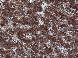 PNPO Antibody - IHC of paraffin-embedded Carcinoma of Human liver tissue using anti-PNPO mouse monoclonal antibody.