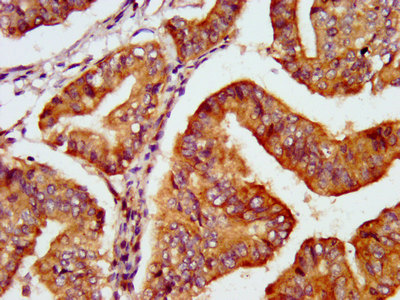 PNPO Antibody - Immunohistochemistry image at a dilution of 1:600 and staining in paraffin-embedded human endometrial cancer performed on a Leica BondTM system. After dewaxing and hydration, antigen retrieval was mediated by high pressure in a citrate buffer (pH 6.0) . Section was blocked with 10% normal goat serum 30min at RT. Then primary antibody (1% BSA) was incubated at 4 °C overnight. The primary is detected by a biotinylated secondary antibody and visualized using an HRP conjugated SP system.