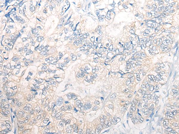 PNPO Antibody - Immunohistochemistry of paraffin-embedded Human gastric cancer tissue  using PNPO Polyclonal Antibody at dilution of 1:30(×200)