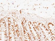 PNPT1 Antibody - IHC of paraffin-embedded Colon ca using PNPase antibody at 1:250 dilution.