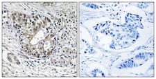 PNPT1 Antibody - Immunohistochemistry analysis of paraffin-embedded human breast carcinoma tissue, using PNPT1 Antibody. The picture on the right is blocked with the synthesized peptide.
