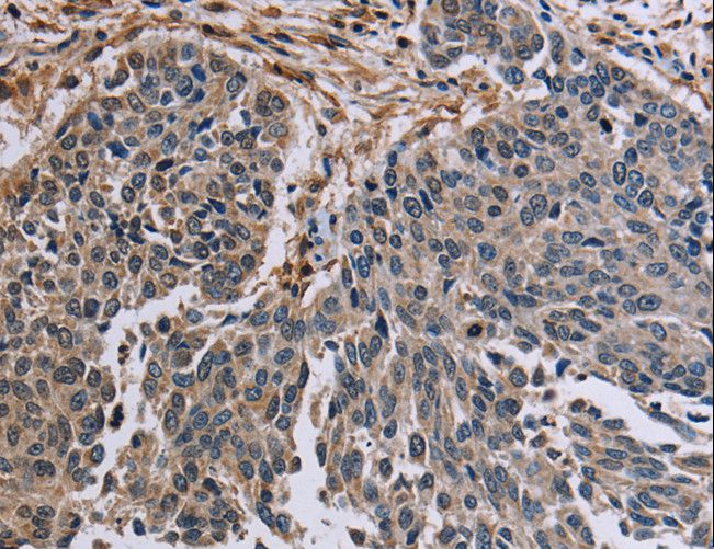 PNPT1 Antibody - Immunohistochemistry of paraffin-embedded Human lung cancer using PNPT1 Polyclonal Antibody at dilution of 1:40.