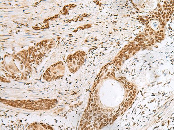 PNRC2 Antibody - Immunohistochemistry of paraffin-embedded Human esophagus cancer tissue  using PNRC2 Polyclonal Antibody at dilution of 1:30(×200)