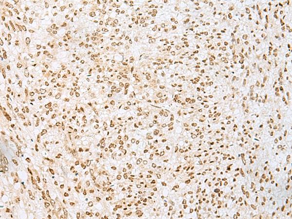 PNRC2 Antibody - Immunohistochemistry of paraffin-embedded Human liver cancer tissue  using PNRC2 Polyclonal Antibody at dilution of 1:30(×200)