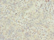POC1B / WDR51B Antibody - Immunohistochemistry of paraffin-embedded human bladder cancer at dilution 1:100