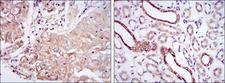 PODXL / Podocalyxin Antibody - IHC of paraffin-embedded lung cancer tissues (left) and kidney tissues (right) using PODXL mouse monoclonal antibody with DAB staining.