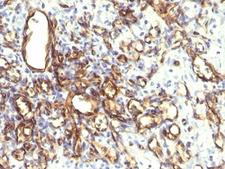 PODXL / Podocalyxin Antibody - Formalin-fixed, paraffin-embedded human angiosarcoma stained with Podocalyxin antibody (2A4).  This image was taken for the unmodified form of this product. Other forms have not been tested.