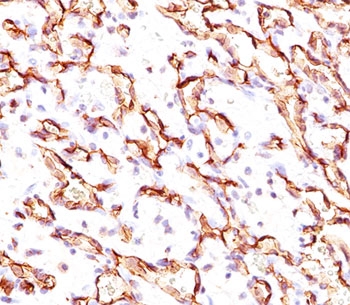 PODXL / Podocalyxin Antibody - Podocalyxin antibody 3D3 immunohistochemistry angiosarcoma.  This image was taken for the unmodified form of this product. Other forms have not been tested.