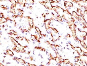 PODXL / Podocalyxin Antibody - IHC testing of angiosarcoma stained with Podocalyxin antibody.