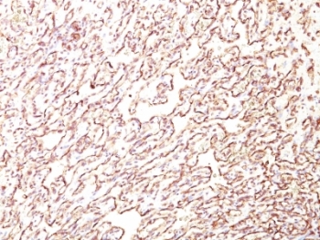 PODXL / Podocalyxin Antibody - Formalin-fixed, paraffin-embedded human angiosarcoma stained with PODXL antibody (4F10).  This image was taken for the unmodified form of this product. Other forms have not been tested.