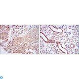 PODXL / Podocalyxin Antibody - Immunohistochemistry (IHC) analysis of paraffin-embedded Lung Cancer Tissues (left) and kidney tissues (right) with DAB staining using Podocalyxin-like 1 Monoclonal Antibody.